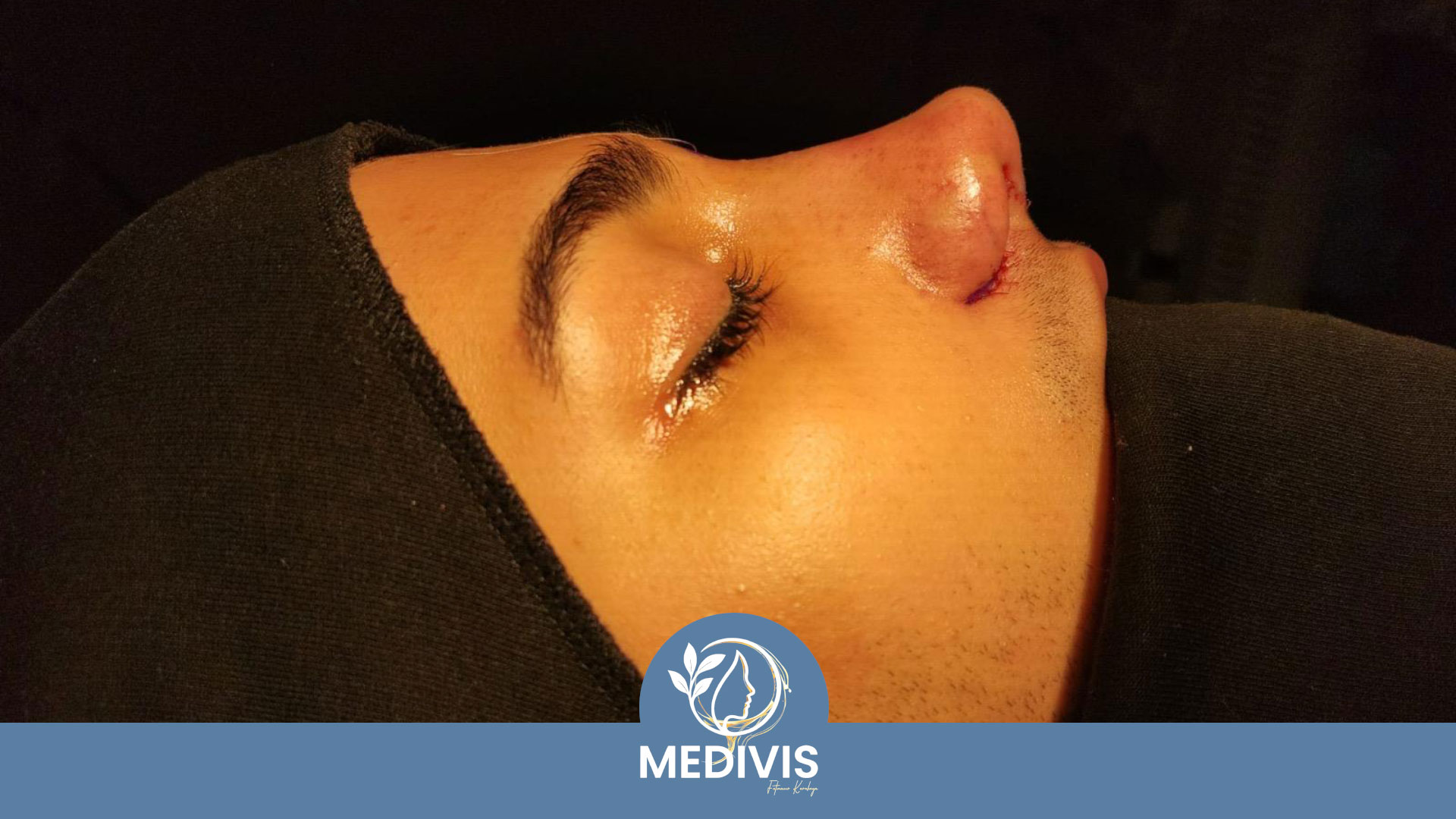 Piezo Rinoplasti - Doğal Profil - Sonrası