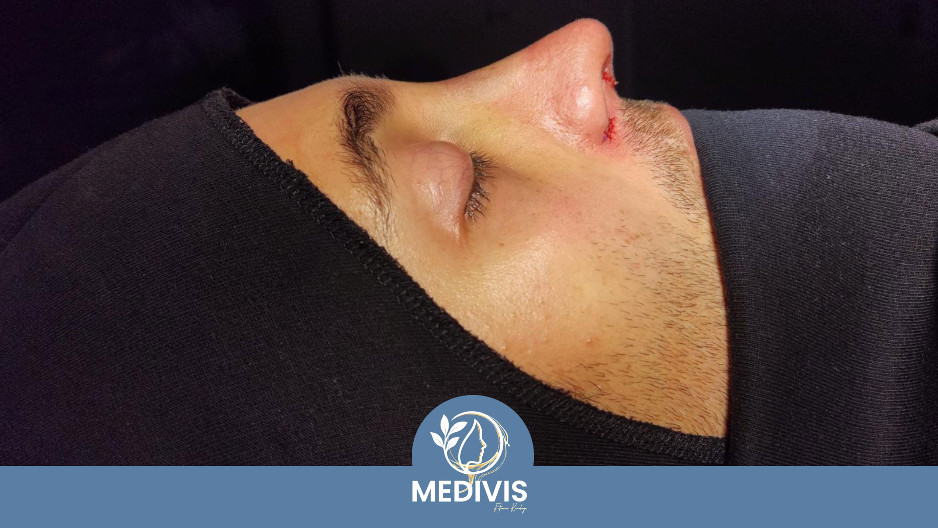 Revizyon Rinoplasti - Yapısal Destek - Sonrası