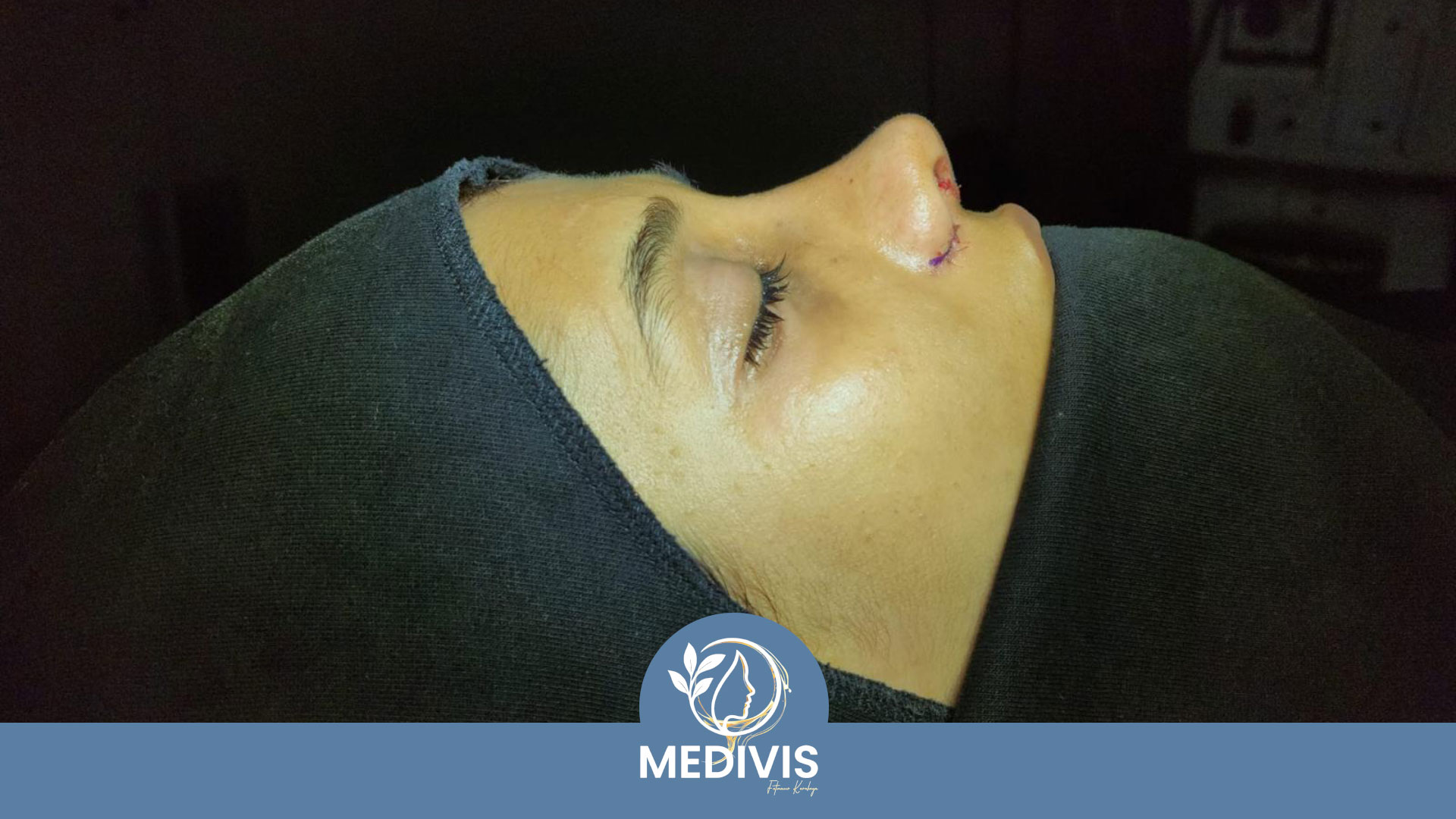 Fonksiyonel Rinoplasti - Nefes Konforu - Sonrası