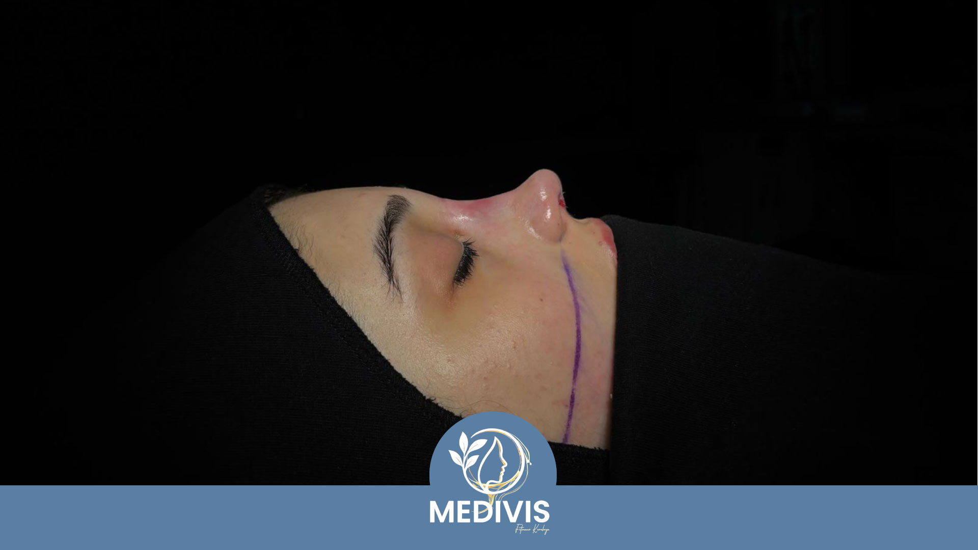 Etnik Rinoplasti - Uyumlu Simetri - Sonrası