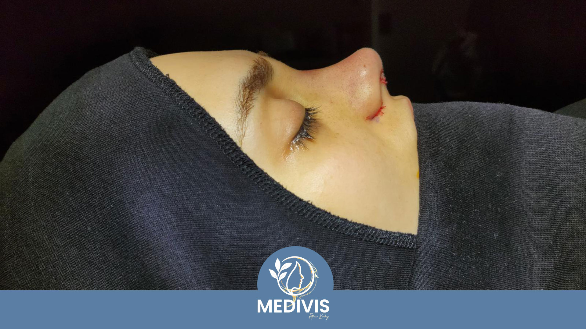 Burun Ucu Estetiği - Net Kontur - Sonrası