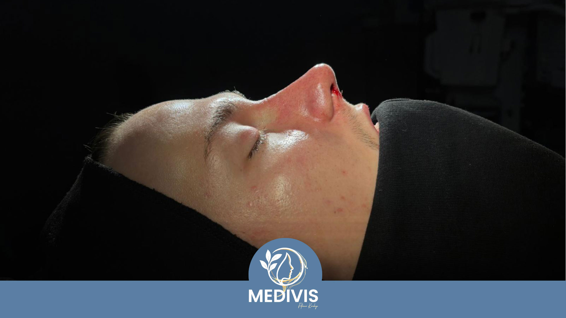 Ameliyatsız Dolgu - Dengeli Profil - Sonrası