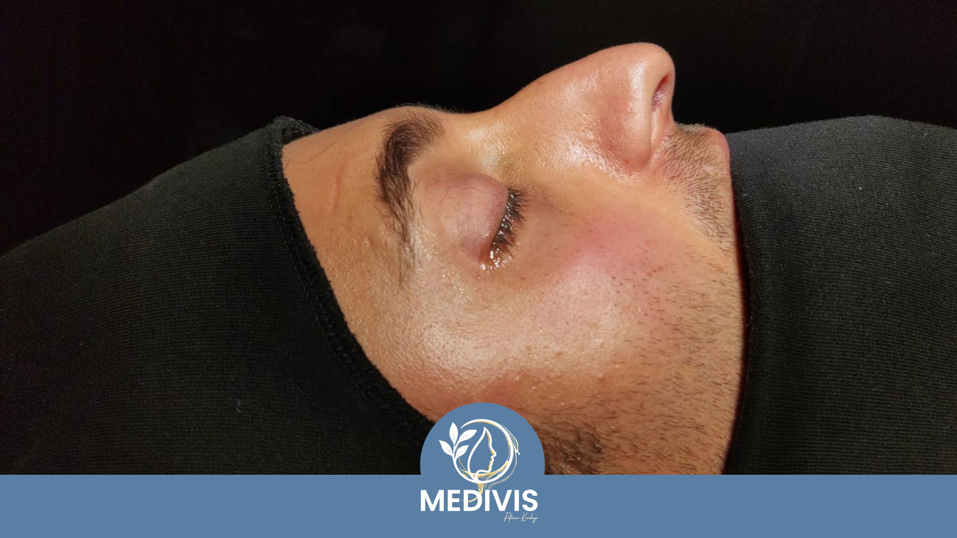 Revizyon Rinoplasti - Yapısal Destek - Öncesi