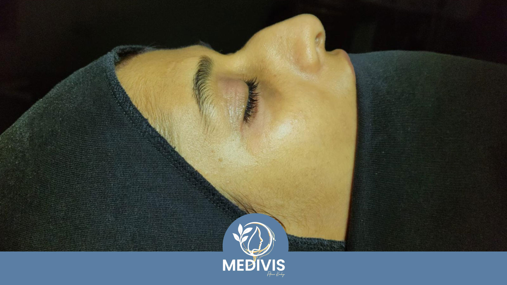 Fonksiyonel Rinoplasti - Nefes Konforu - Öncesi