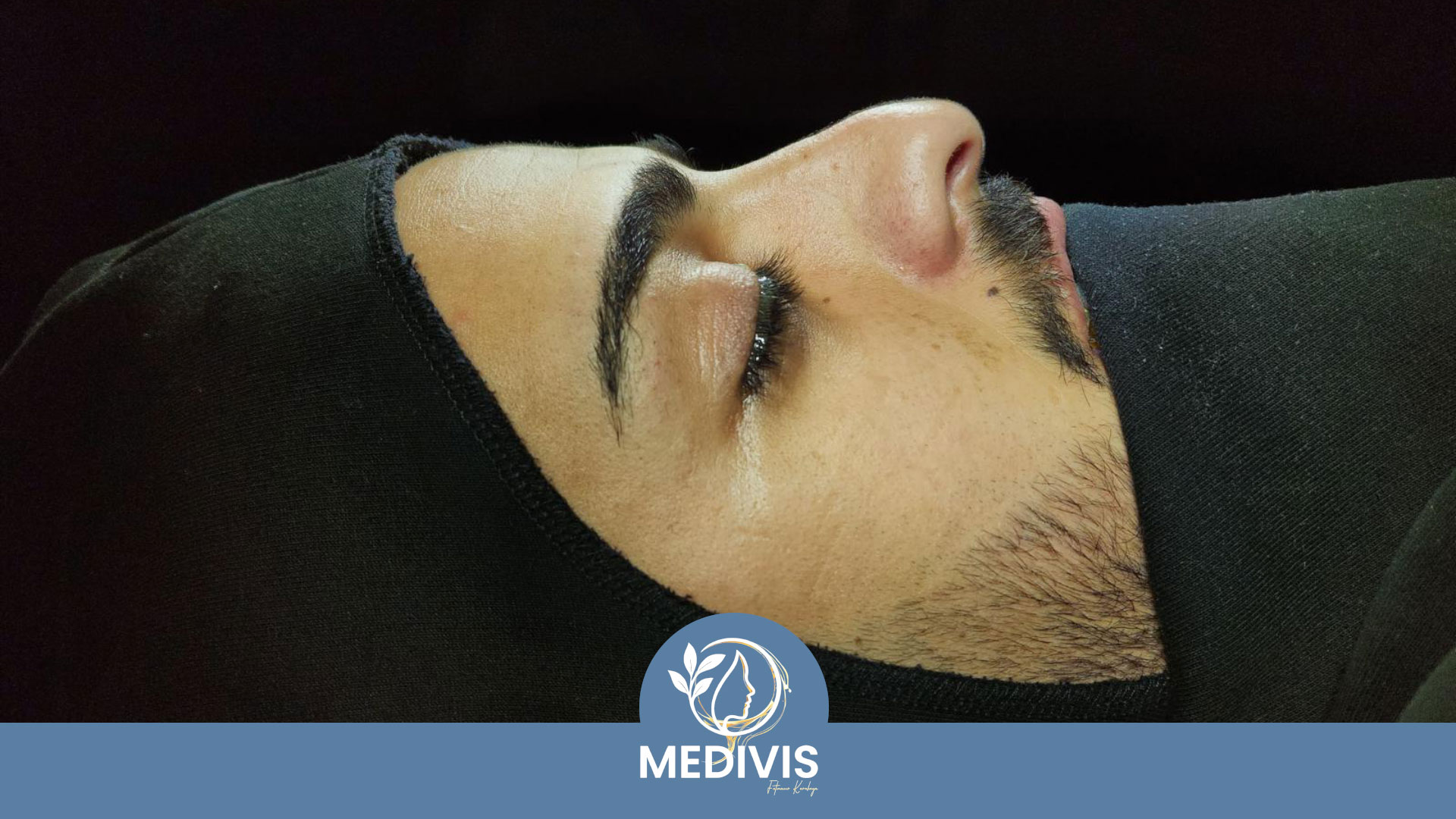 Koruyucu Rinoplasti - Yumuşak Geçiş - Öncesi