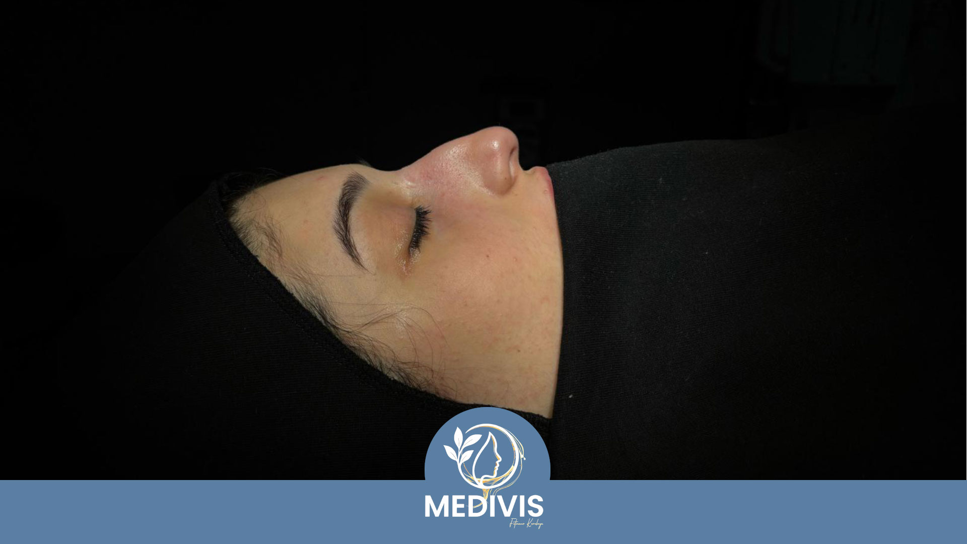 Etnik Rinoplasti - Uyumlu Simetri - Öncesi