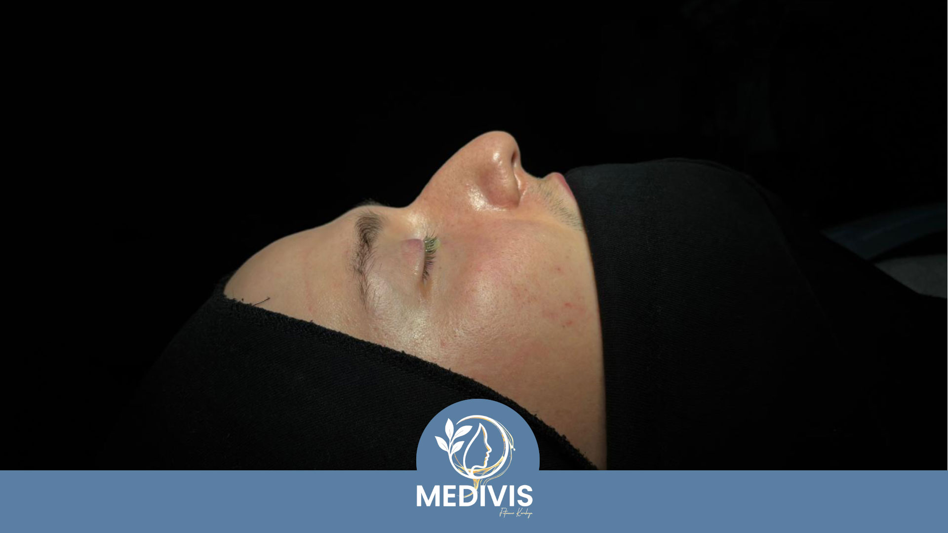 Ameliyatsız Dolgu - Dengeli Profil - Öncesi