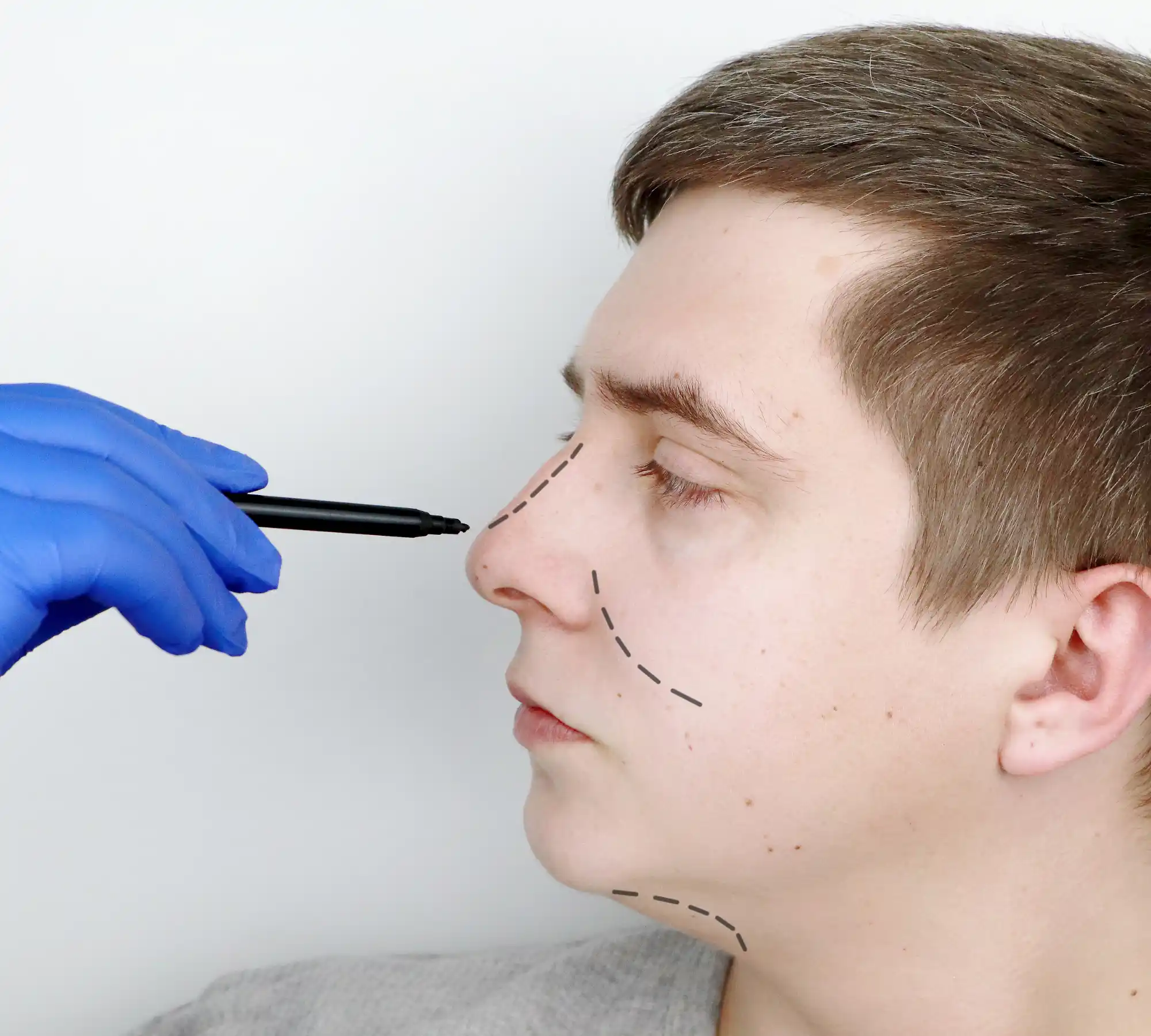 Tipplasti ile Burun Ucu Şekillendirme