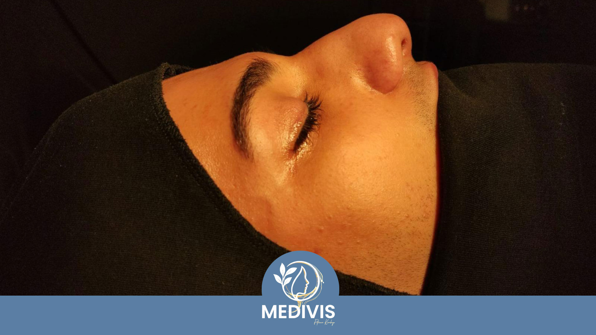 Piezo Rinoplasti - Doğal Profil - Öncesi